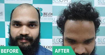 Before and After 4